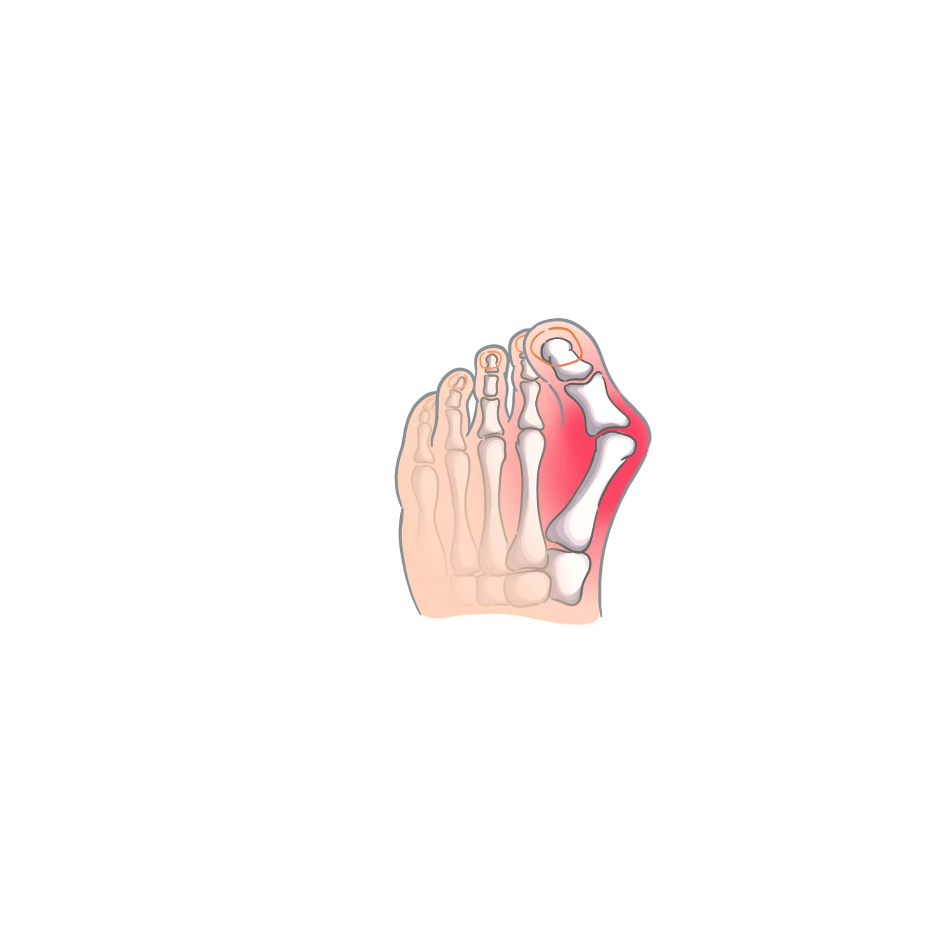 Deformity nožních kostí – hallux valgus